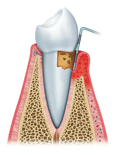 Gum Disease Periodontitis Phoenix Ahwatukee AZ