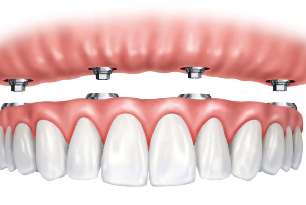 Traditional Dentures Implant Supported Dentures